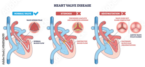 Heart valve disease diagram compares normal, stenosis, and regurgitation, shows heart, aortic valve, and blood flow arrows to explain function and defects. Outline diagram