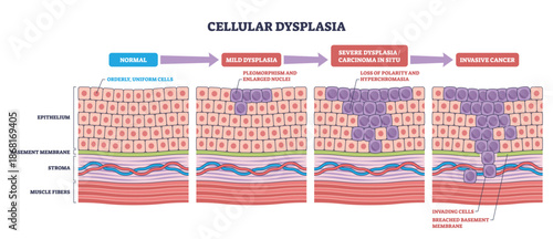 Cellular dysplasia diagram maps stages from normal epithelium to carcinoma in situ and invasive cancer, key elements, epithelial cells, nuclei, basement membrane. Outline diagram