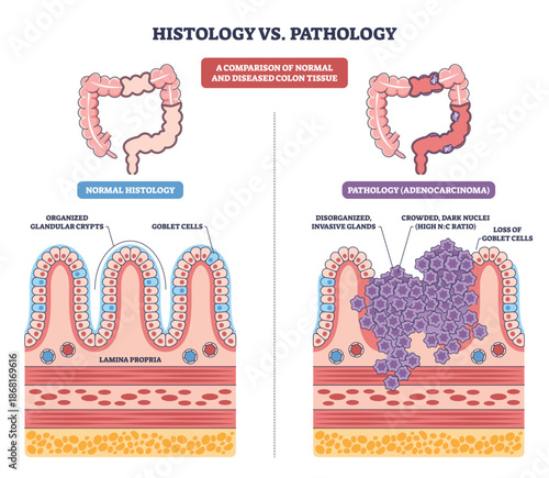 Histology vs Pathology shows colon tissue comparison, normal crypts with goblet cells versus adenocarcinoma tumor mass. Main objects, colon, crypts, tumor cells. Outline diagram