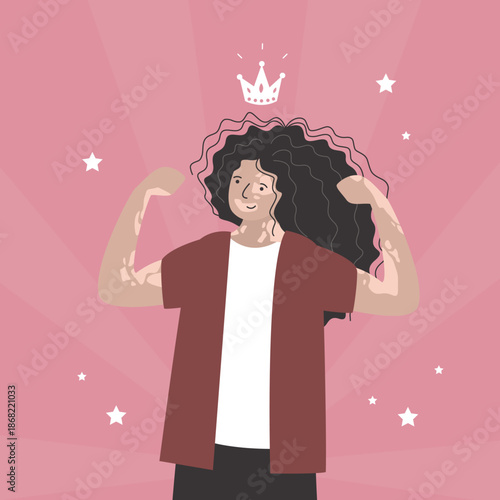 Caucasian woman with vitiligo. Self care and self love. World vitiligo day. Skin disease. Strong girl wearing crown. Female portrait.