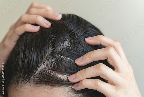 Woman Scratching Scalp with Visible Dandruff Flakes.