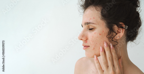 Konstfotografi face of a young girl with pimples and red acne close-up on a white background