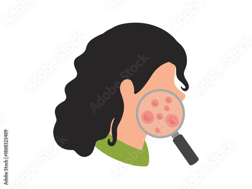 Acne Papula in Face Skin Illustration