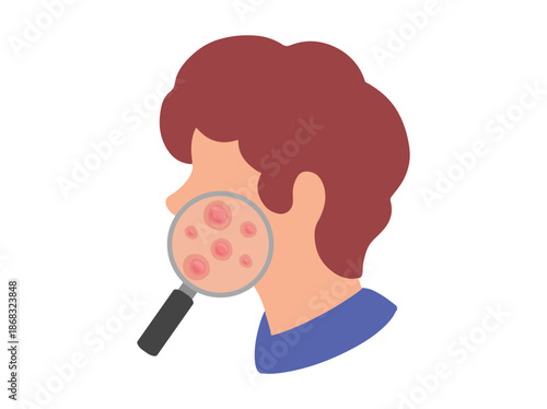 Acne Papula in Face Skin
