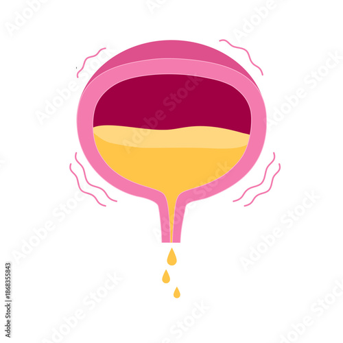 Urinary incontinence. Process of spontaneous release or leakage of urine due to various factors.
