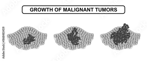 Vector illustration of malignant tumor growth. The development of cancer cells, tumors, spread. Medical diagram illustration for poster, education, science and health elements.
