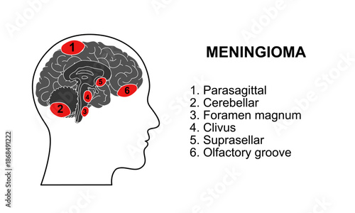 location of meningioma in the brain. Tumors in the brain membrane and spinal cord. Inflammation of meninges. Vector drawing illustrations for medical, posters, health and education.