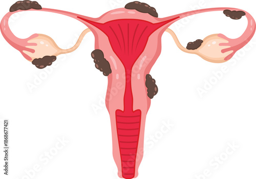 Illustration of a uterus with fibroids on transparent background