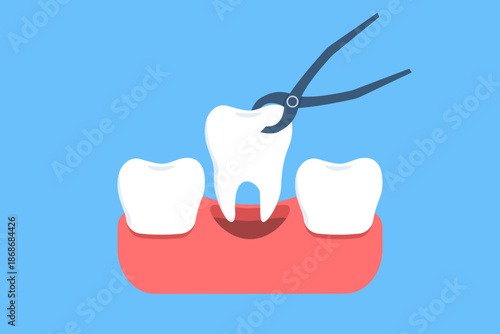 Vector illustration of tooth extraction procedure with dental forceps removing a tooth. Concept of dental surgery, oral medicine, and professional dental treatment.