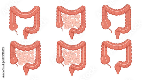 Medical illustration of the human digestive system, showing the colon and small intestine