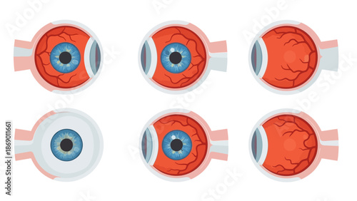 Eye Anatomy A Detailed Vector Illustration Showcasing Various Eye Conditions and Structures