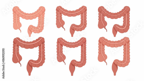 Human Colon Illustration Healthy and Diseased Variations for Medical Education and Research