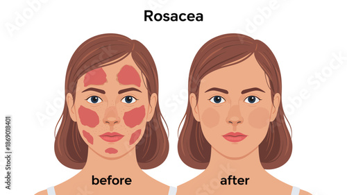 Rosacea Skin Condition Before After Female Face Medical Illustration