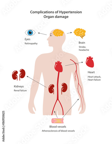 Complications of Hypertension. Organ damage. Medical illustration showing the human body, target organs, and possible diseases. Vector illustration in a flat style isolated over white background
