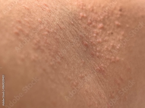 Bild auf Leinwand Close-up of skin texture showing red bumpy rash.
