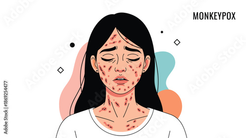 Concerned young woman shows signs of monkeypox infection with visible red rashes and blisters on her face and neck in a medical concept.