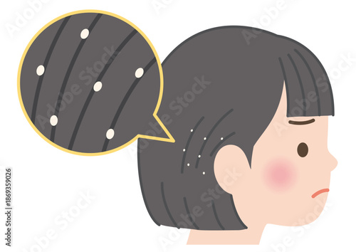 髪にアタマジラミの卵が付着している子供