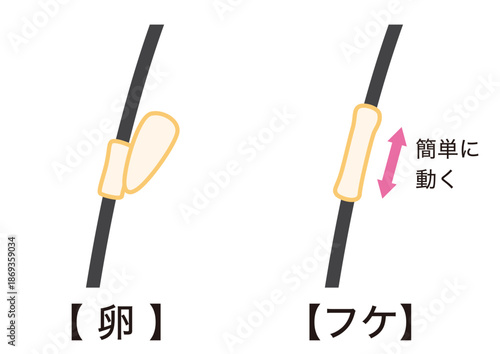 アタマジラミの卵とフケの見分け方