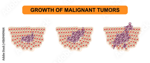 Vector illustration of malignant tumor growth. The development of cancer cells, tumors, spread. Medical diagram illustration for poster, education, science and health elements.