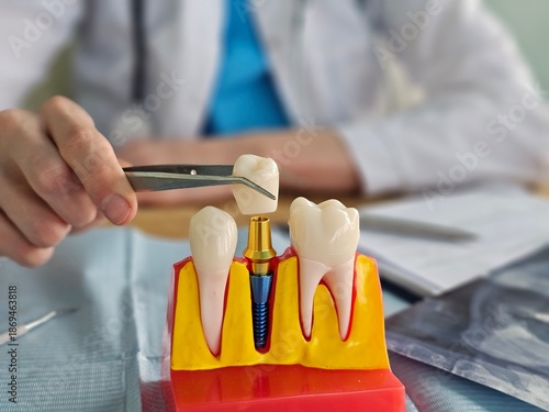 Fotografi Model of dental implant procedure being demonstrated by a dentist
