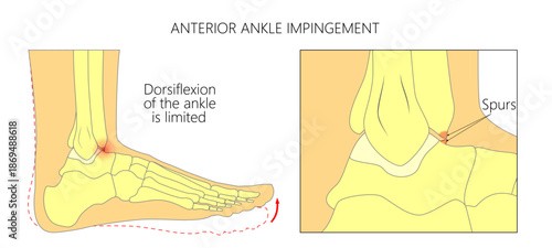 Anterior ankle impingement