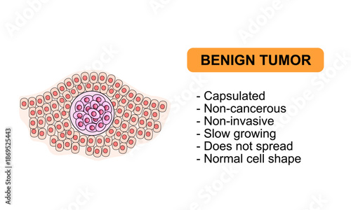 Vector Illustration of a benign tumor. Characteristics of benign tumors, non cancerous. Illustration for medical diagrma, design element, poster, or education.