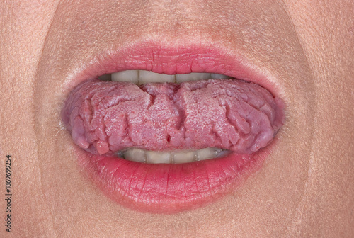 Tablou pe pânză Close up of a fissured tongue (Lingua plicata)