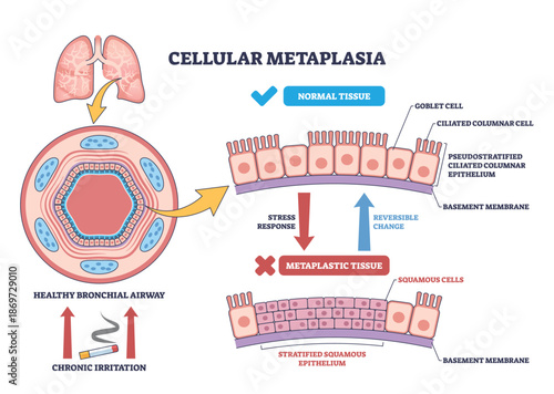 Cellular metaplasia illustrated, airway epithelium shifts from ciliated columnar to stratified squamous under stress, lungs, cilia, squamous cells highlighted. Outline diagram