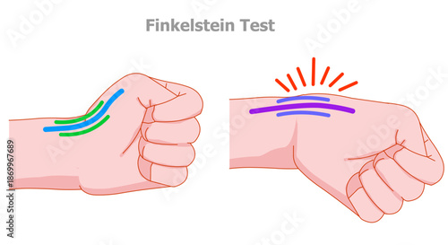 Finkelstein test. Used to test for De Quervain's tenosynovitis of the wrist. make a fist around the thumb. Illustration vector