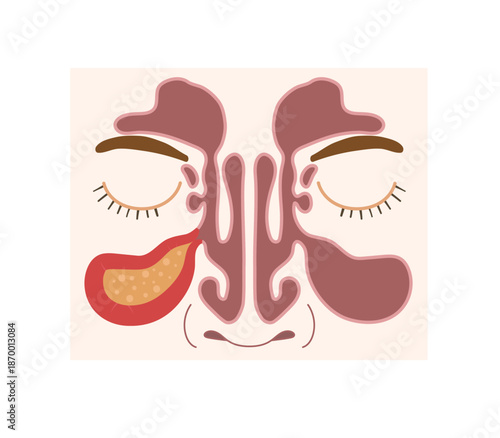 Sinusitis healthy and inflamed nasal sinuses. Human anatomy scientific illustration.