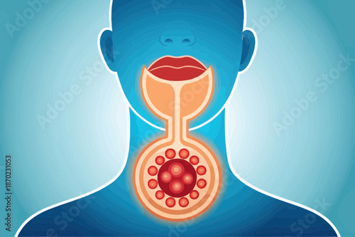Diphtheria Infection Illustrated in Human Throat