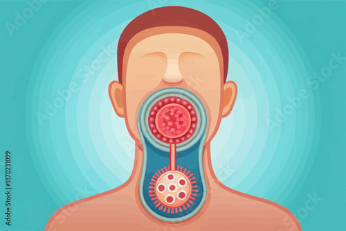Diphtheria Infection in Human Throat Medical Illustration