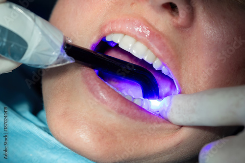Foto Close-up of dentist using dental curing light to harden material during tooth restoration