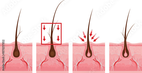 Hair Follicle Anatomy and Stages of Hair Growth and Loss IllustrationHair Follicle Anatomy and Stages of Hair Growth and Loss Illustration