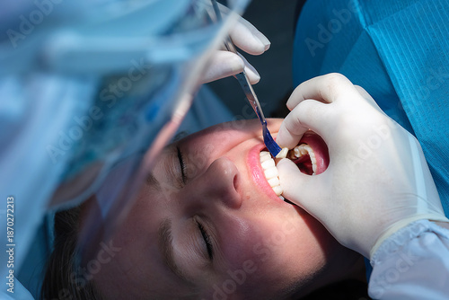 Dentist trying in a dental crown and checking bite contacts with articulating paper before final fixation. Precision fitting during restorative dental procedure.