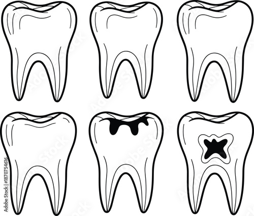 Tooth decay progression illustration set, healthy and damaged teeth, dental care, cavity stages, oral health, outline vector