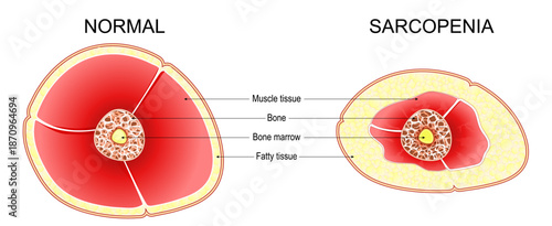 Sarcopenia. Age-related muscle atrophy. 