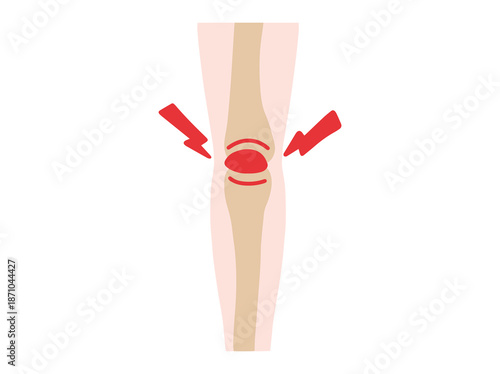 Bursitis Prepatellar Disease in Knee Illustration
