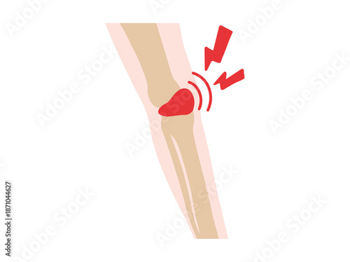 Bursitis Prepatellar Disease in Knee