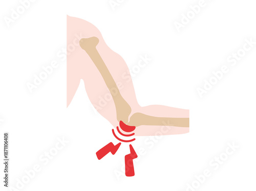 Bursitis Olecranon Disease in Elbow Illustration
