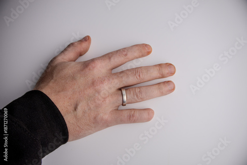 The right hand of an adult person with a scar and missing part of the little finger