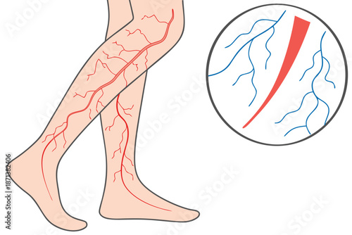 Detailed Medical of Varicose Veins in Human Leg with Cross Section vessels circulatory system vein medical diagram