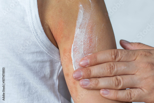 Photos Close-up of a hand applying white cream to a child's irritated arm skin, visible