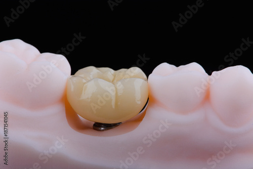 Two dental crown of molar made of zirconium on titanium abutments for fixation to implant