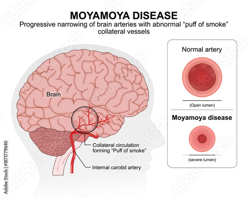 Moyamoya Disease Medical Flashcard Illustration