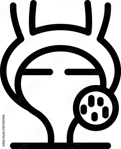 Bladder stones causing pain and discomfort, a common urological issue requiring medical attention