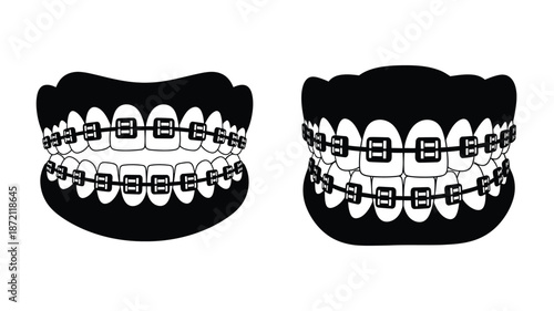 Detailed view of teeth with braces showing alignment and brackets silhouette