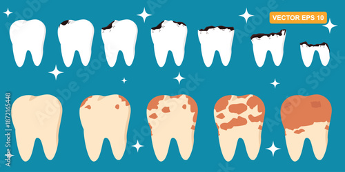 Vector Collection of flat illustrations of tooth decay problems, the process of tooth decay from small cavities to holes. Dull teeth, tooth stains. Suitable for Oral Health and Education elements.