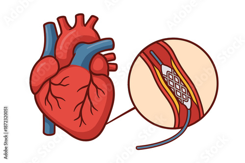 Heart anatomy showing a stent in an artery with detailed view of the structure and placement