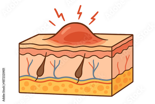 Understanding the structure of skin layers with a focus on inflammation and irritation in the dermis